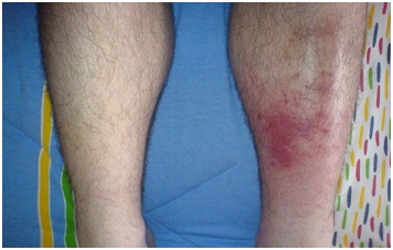 Cellulitis